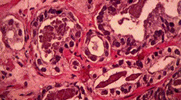 examen de biopsia de prostata en antofagasta