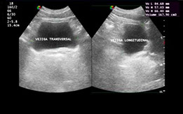 ecografia urologica de vejiga en antofagsta